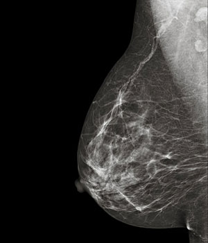 Mamografia-y-prevencion