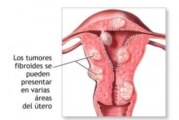 Que es síndrome de ovario poliquístico (SOP) ?