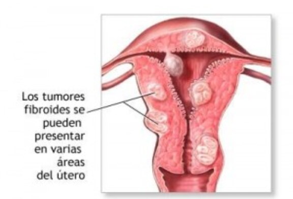 Que es síndrome de ovario poliquístico (SOP) ?