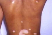 Manchas blancas en la piel, por Vitiligo, causas y definiciones