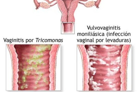 Tricomoniasis, que la causas y cuales son sus molestias.