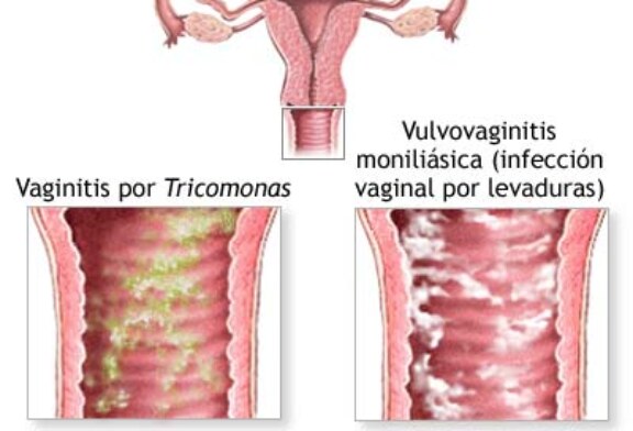 Tricomoniasis, que la causas y cuales son sus molestias.