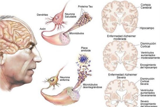 Simples trucos, adios al Alzheimer, simple y efectivo.