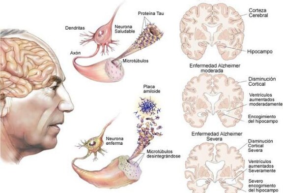 Simples trucos, adios al Alzheimer, simple y efectivo.